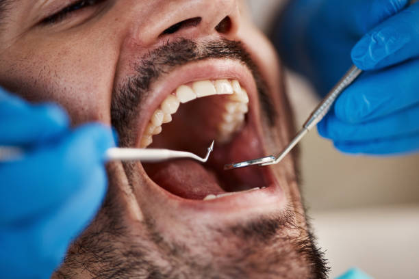 Best Emergency Dentist for Lost Fillings or Crowns in Pennington, NJ
